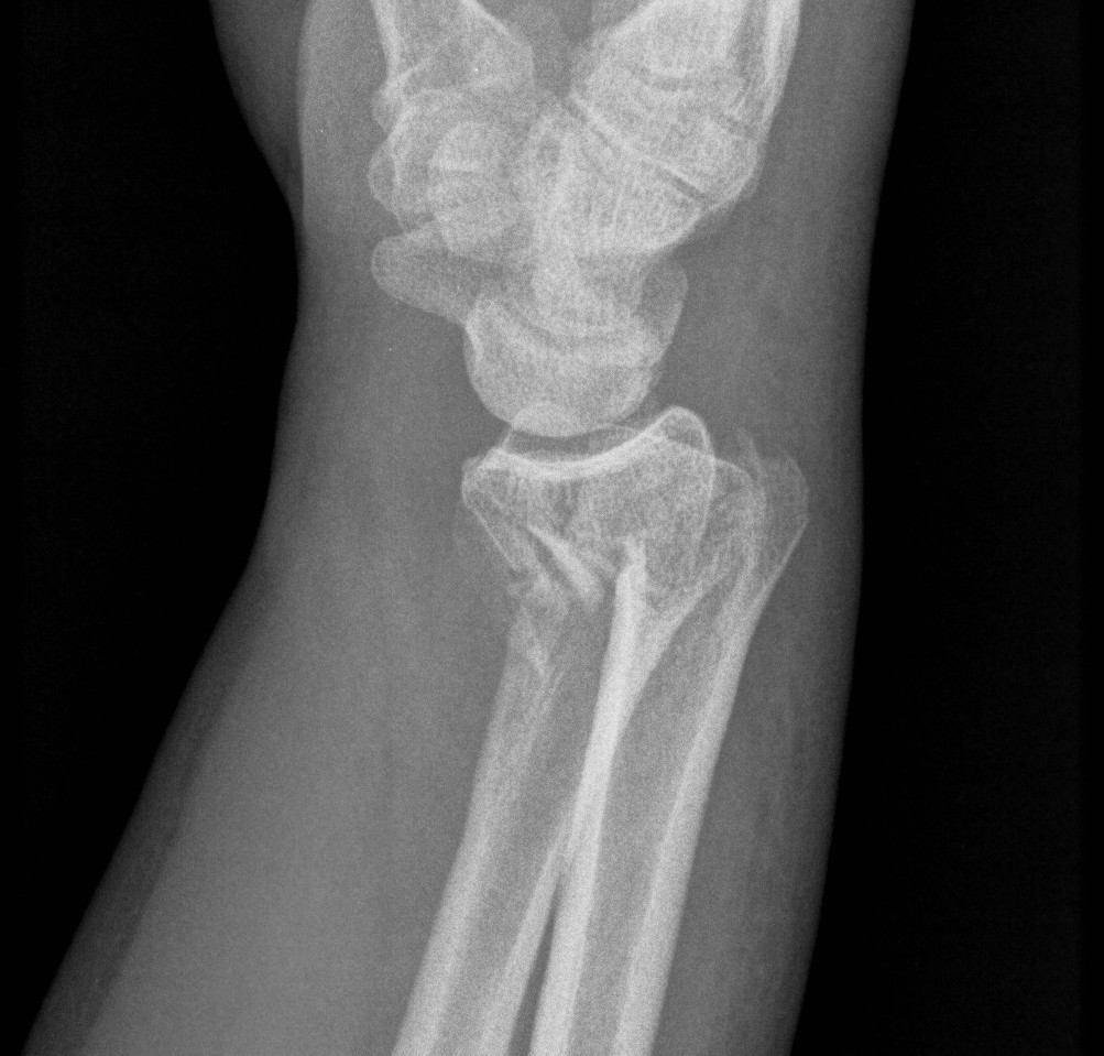 Distal Radius Smiths Fracture